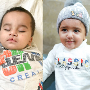 Sponsor a Cleft Lip & Palate Surgery