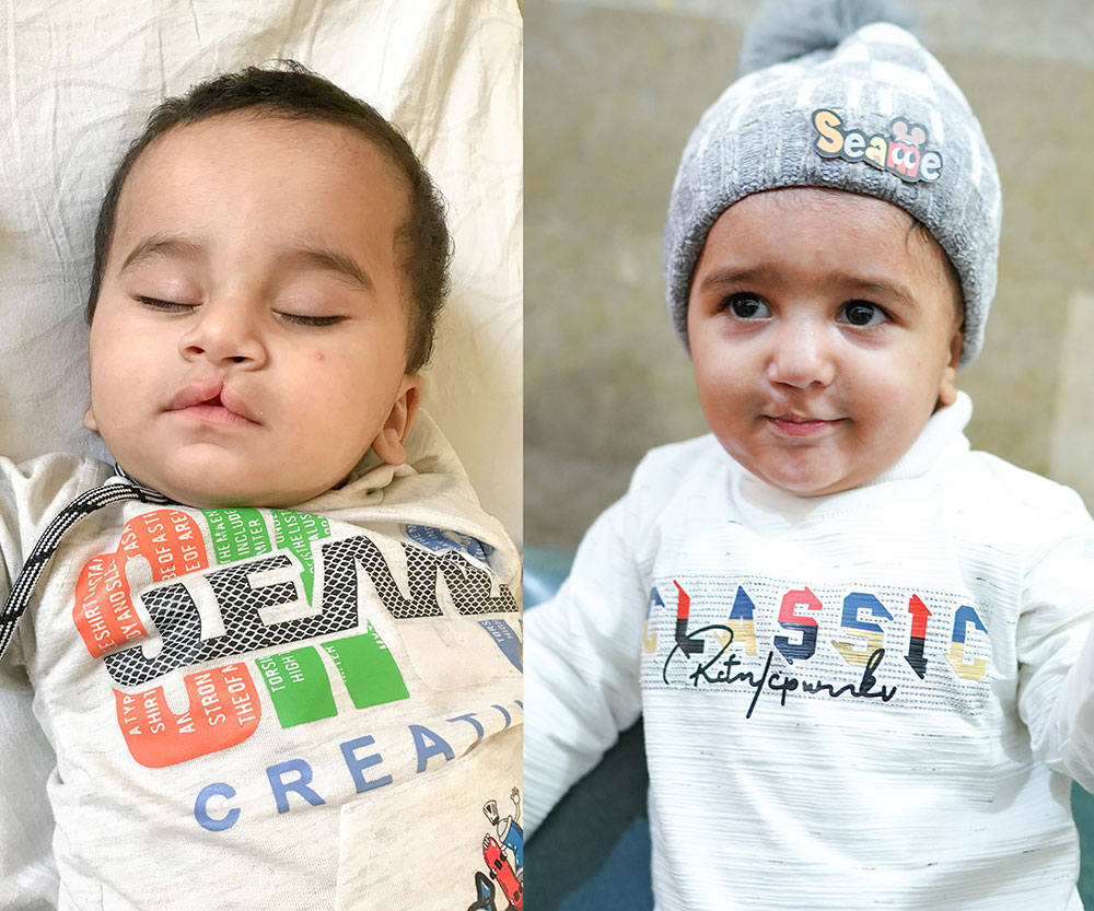 Sponsor a Cleft Lip & Palate Surgery